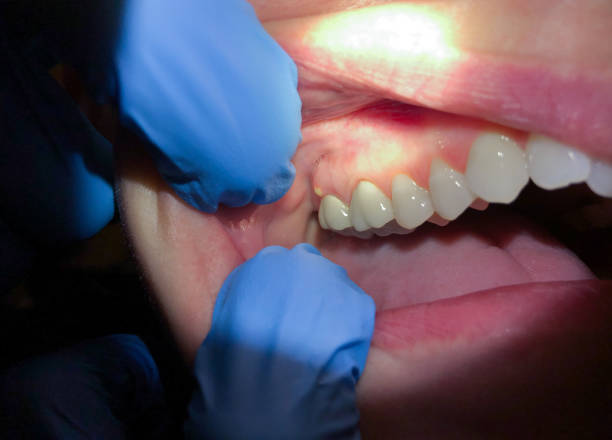 Best Emergency Dentist for Lost Fillings or Crowns in Leola, PA